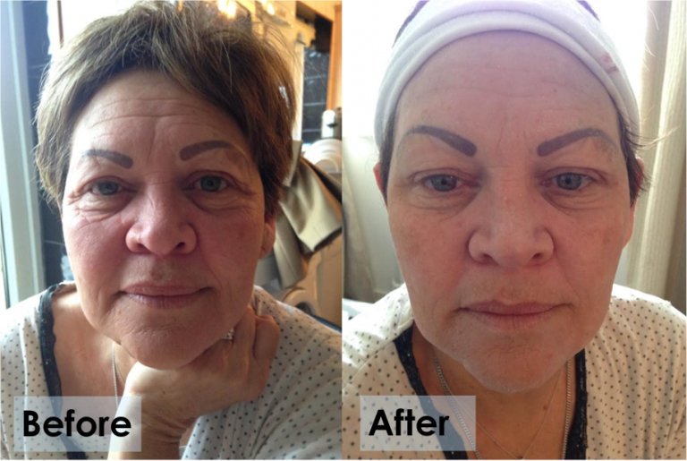 Instant Facelift- Improved?! - skinChemists